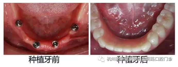 种植牙牙齿缺失最好的修复方案,半口种植牙即刻修复多久能吃东西