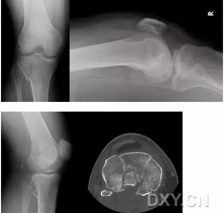 几种严重骨折医学名称,常见的骨折有哪些名称