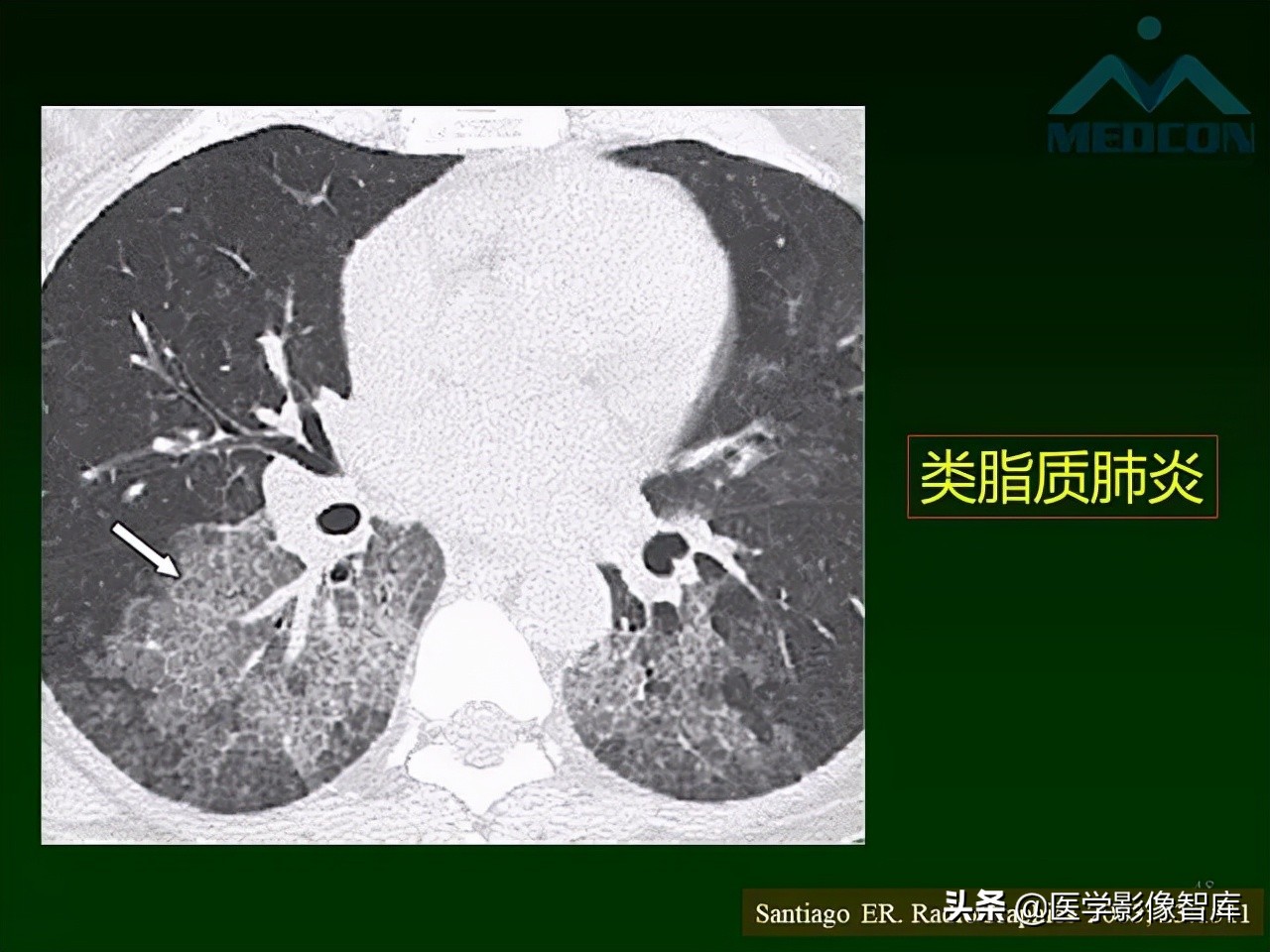 肺弥漫性网状影,两肺小叶间隔增厚可见网状模糊影