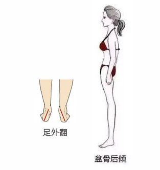 矫正腿型应该找谁,xo型腿矫正最快变直的方法视频