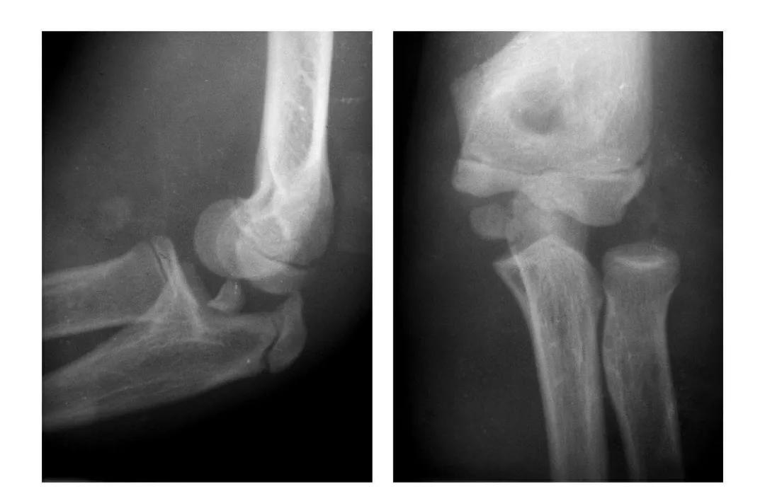 青少年肘部损伤最常见的是,肘部桡神经损伤的临床表现