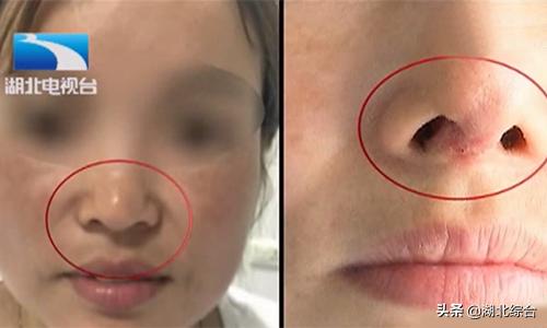 女子花三万多元隆鼻却失败,女子花5万隆鼻变畸形