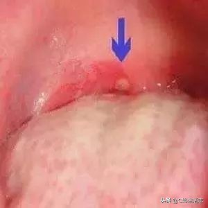 疱疹性咽峡炎恐怖吗,疱疹性咽炎可怕吗