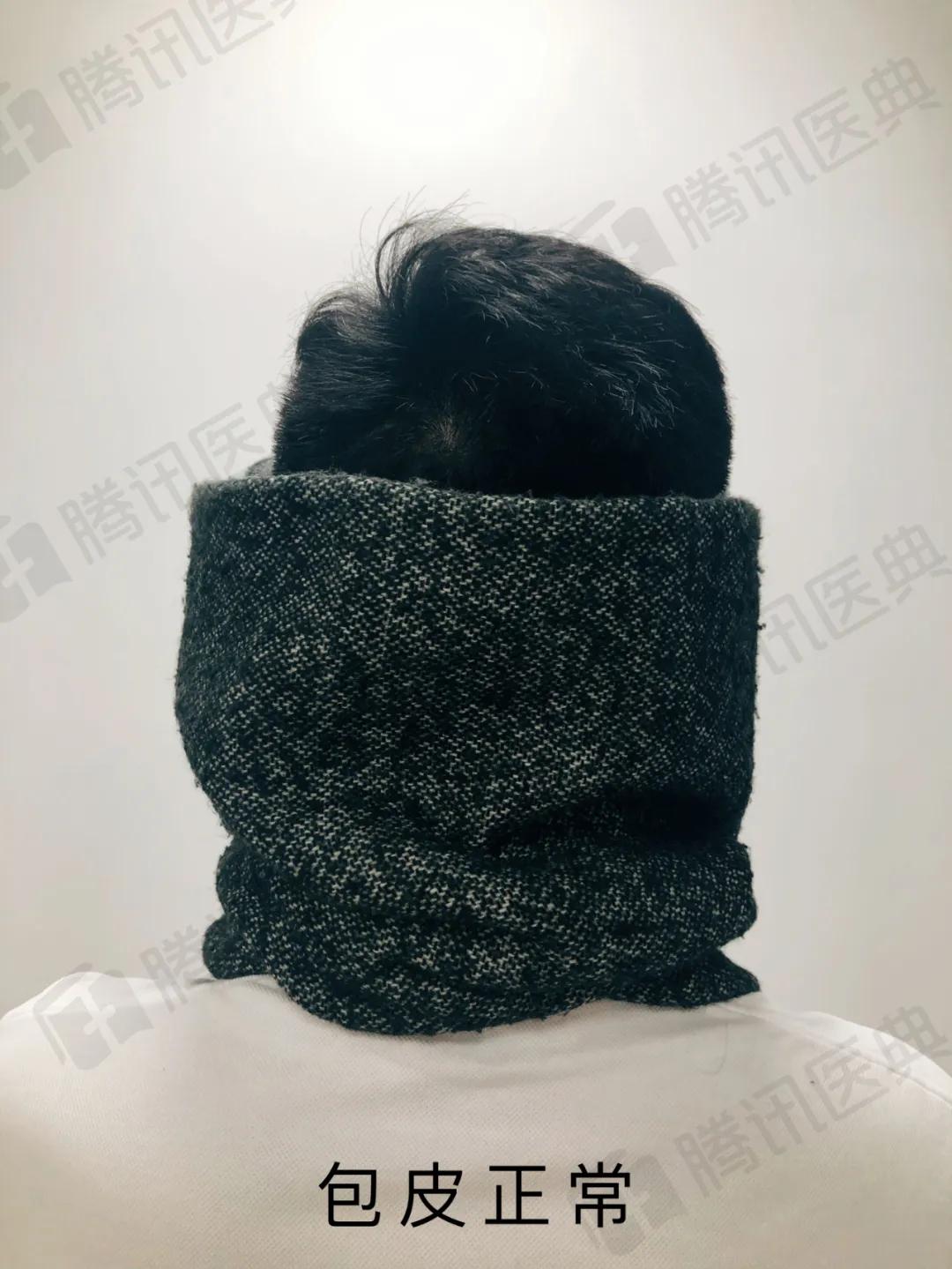 割包皮有割短的情况吗,割包皮有可能割短吗