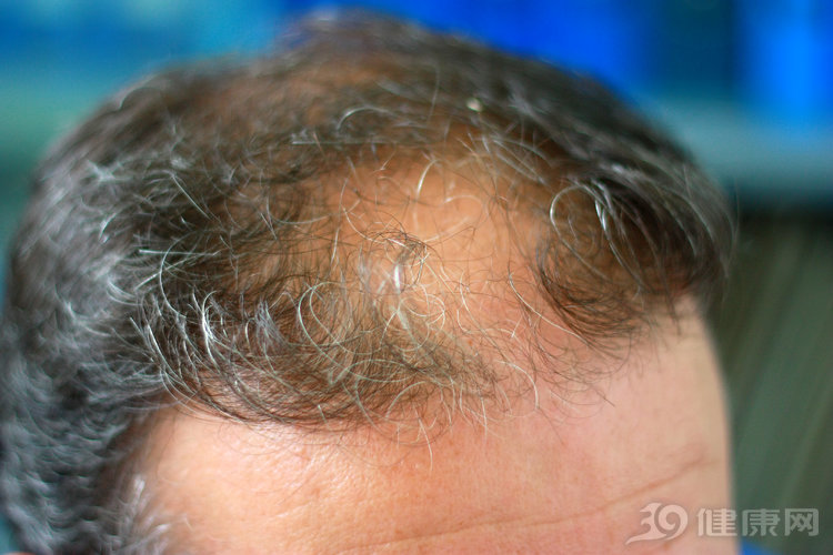 辟谣生发脱发,生发产品虚假宣传不犯法吗