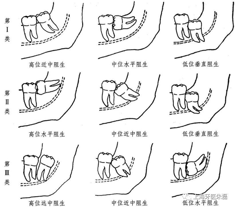 第二磨牙晃动要拔掉阻生智齿吗,埋伏水平阻生智齿拔掉风险