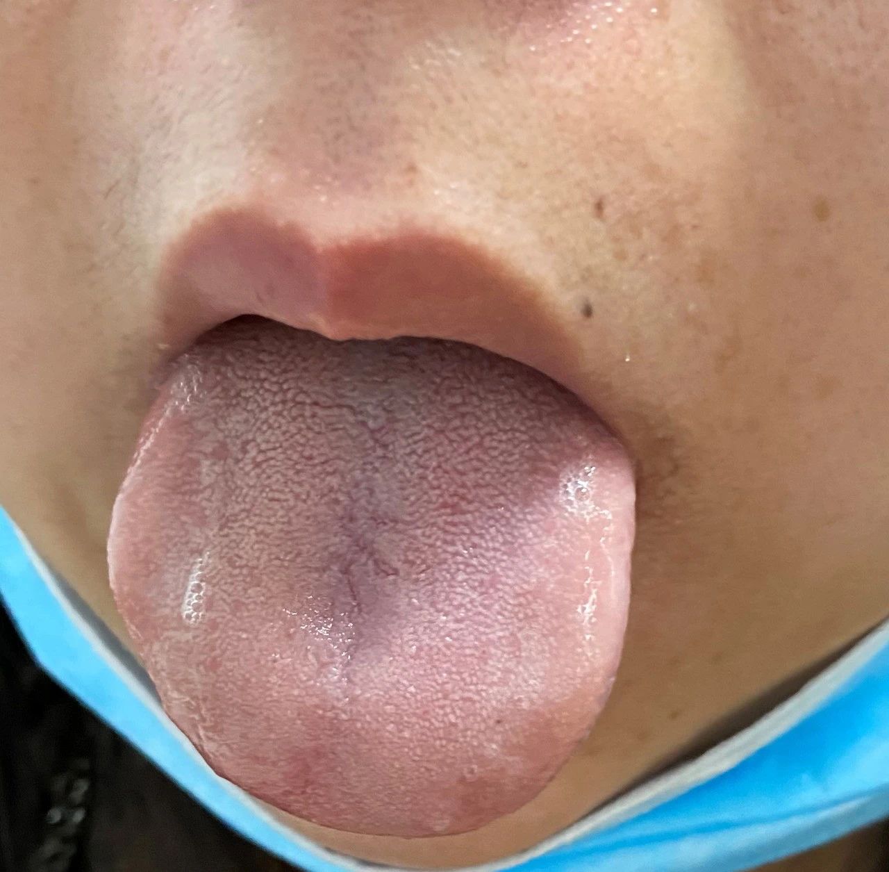 脾虚犯困怎么治疗,脾虚食欲不振中药治疗