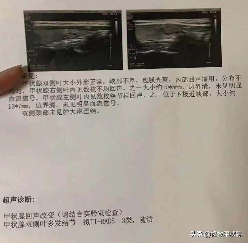 桥本甲状腺炎服中药能否治好,中药桥本甲状腺炎的方子