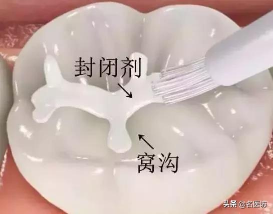 小孩乳牙龋齿要治么,小孩乳牙龋齿了需要治疗么