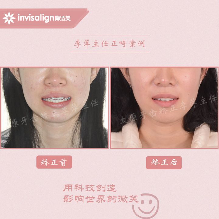 太原矫正牙齿需要做正颌吗,太原牙齿二次矫正