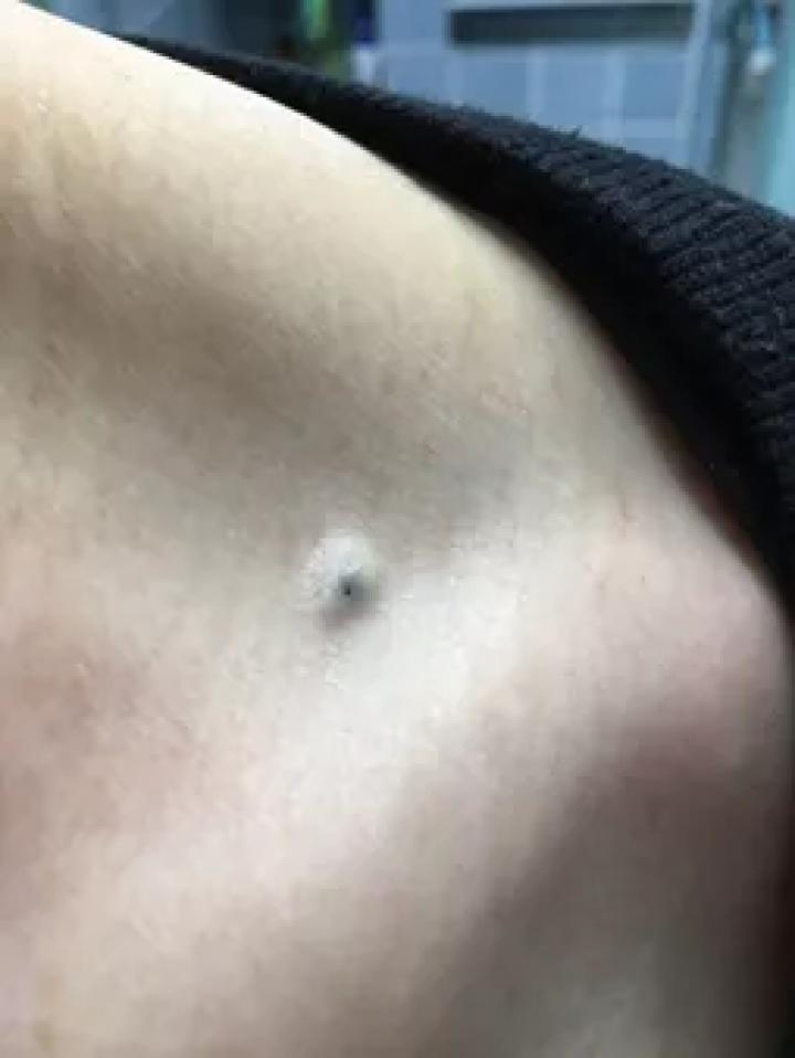 哪些部位长痣预示一生劳碌,痣的位置预示着什么