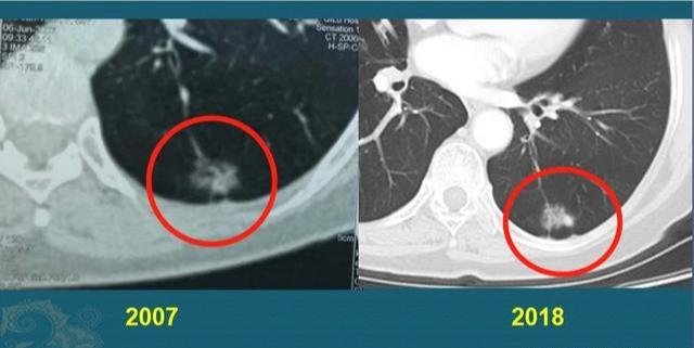 癌症发现就是晚期还有必要体检吗,有些癌症不治没事一治就完了