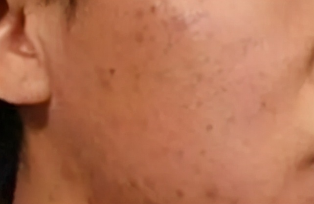 *疮痤**疤痕如何去除*疮痤**疤痕修复方法