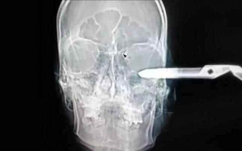 不作死就不会死,看看这些被人类搞进身体里的异物