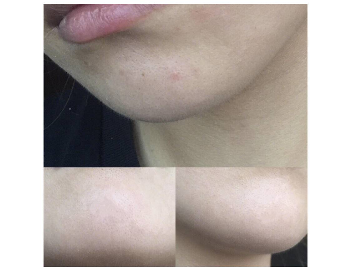 刷酸到底好不好,美容刷酸的副作用是什么