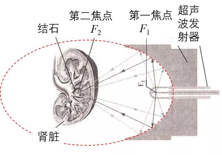 声波消除结石,超声波击碎肾结石有危害吗