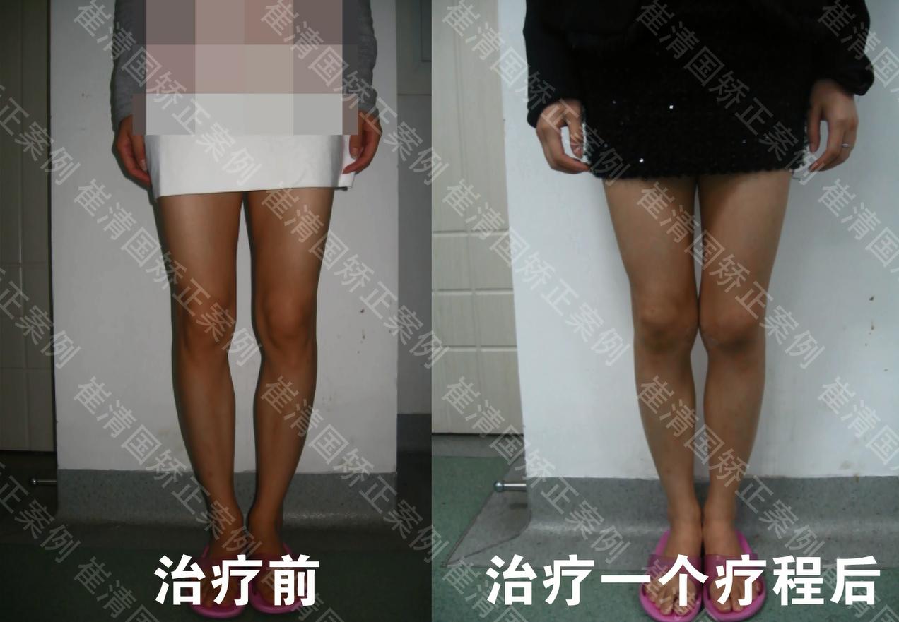 怎么从根本上解决o型腿,告别o型腿最快的方法