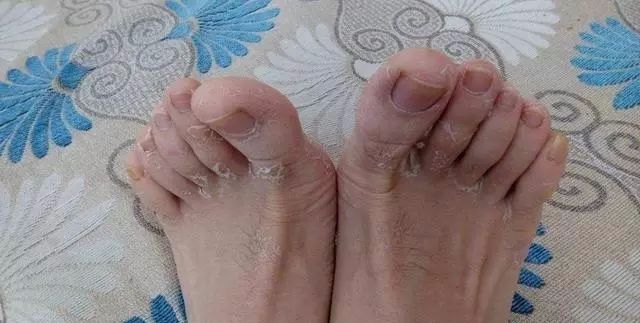 春季脸干燥起皮怎么缓解,脚部一年四季干燥起皮怎么办