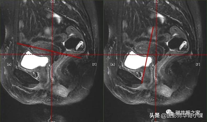 「精品课件」带大家看看,磁共振子宫MRI要如何扫描?