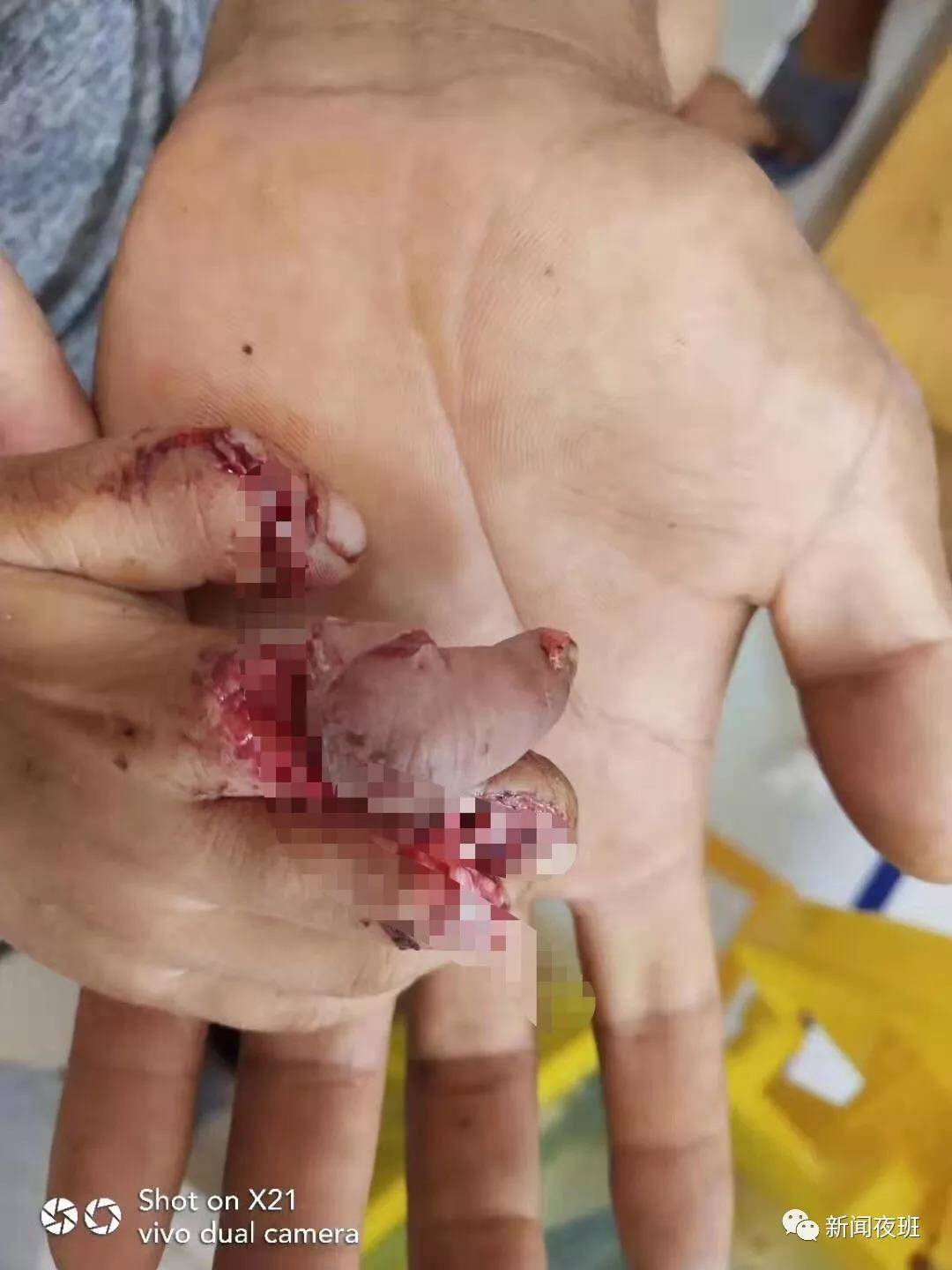 广西一3岁男童在路边玩不慎被石头砸断三根手指