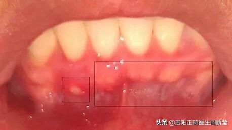 以前装假牙哪里痛了怎么办,老年人戴假牙引起的牙痛怎么用药