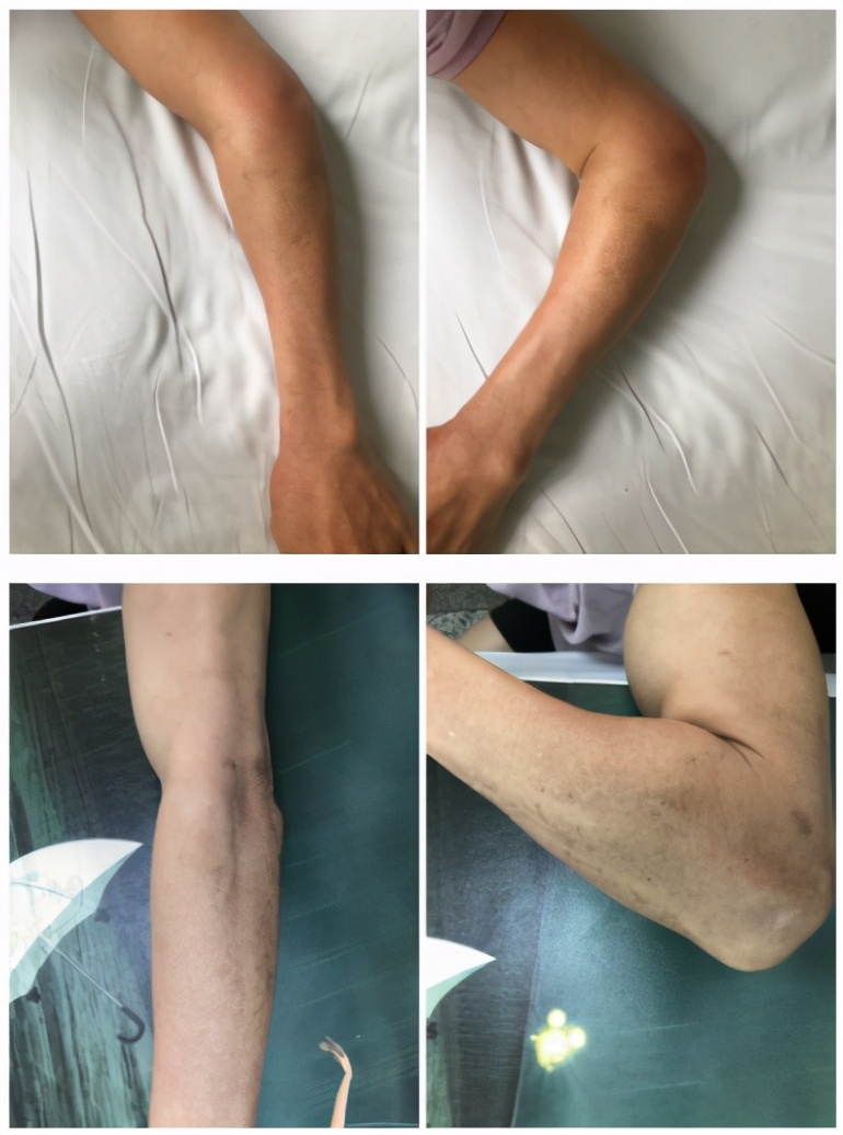 痛风踝关节炎症状,痛风关节炎早发现早治好