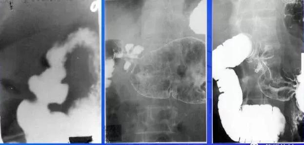 十二指肠球部溃疡解剖位置,十二指肠球部溃疡x线表现