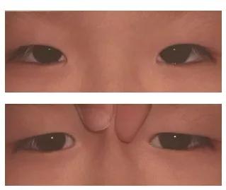 揭开斜视的面纱-内斜视