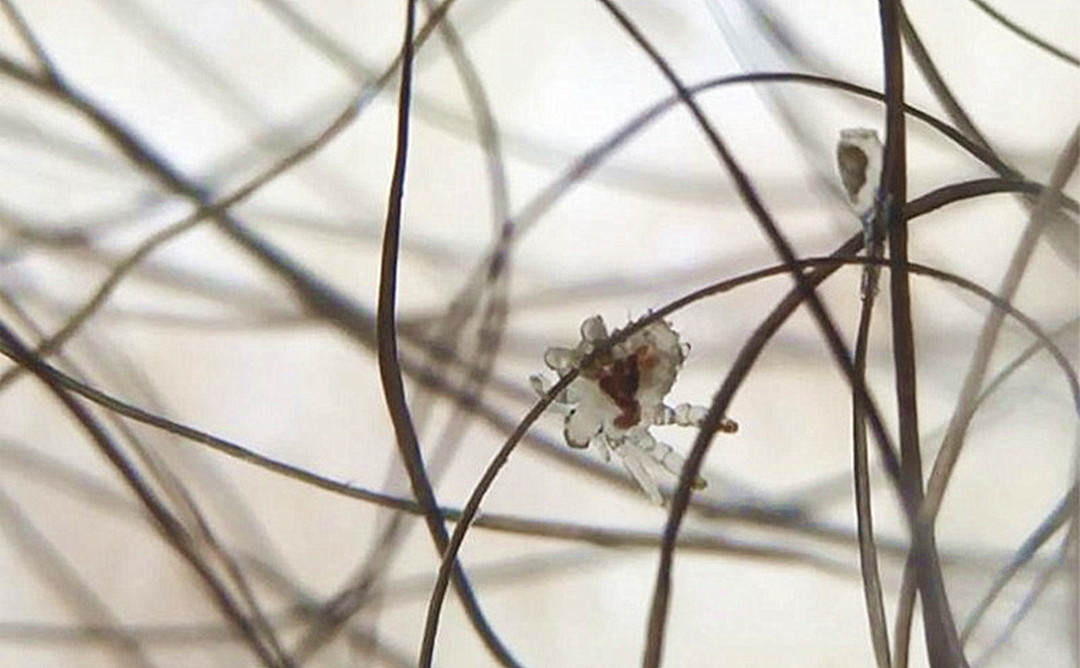 阴虱是什么原因得的知乎,阴虱为啥会出现