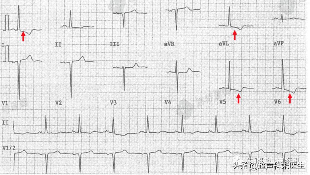 t波倒置9个真相图解,t波倒置判断口诀