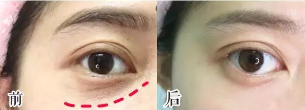 别再用针挑！用米澳拉，脂肪粒自己“掉”下来，效果胜过医美激光