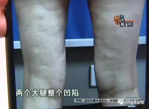 为了丰胸要付出多少代价,脂肪丰胸一个月后发炎取出