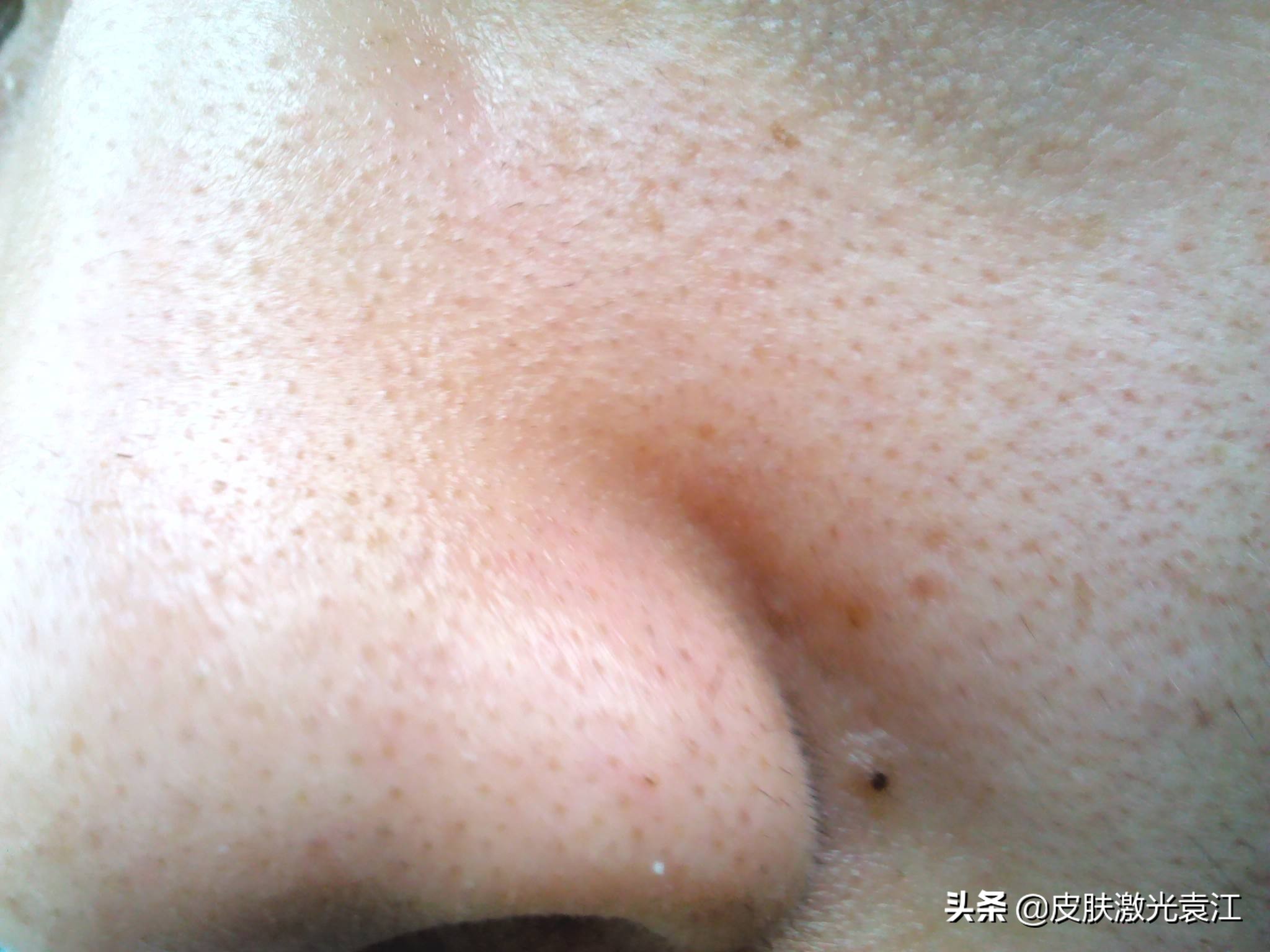 毛孔粗大5种类型改善方法,毛孔粗大程度分级