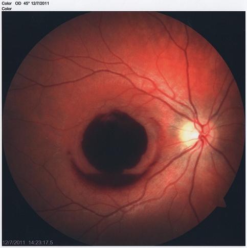眼睛有螨虫用激光有害吗,激光手电对眼睛有伤害吗