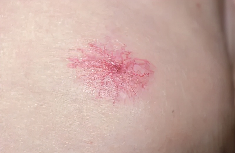 身上长了红色的蜘蛛点怎么回事,身上有蜘蛛红点