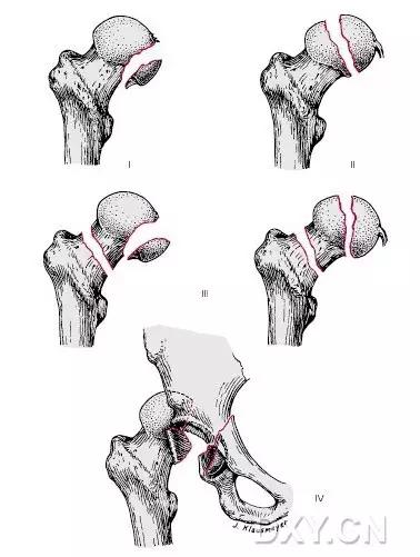 几种严重骨折医学名称,常见的骨折有哪些名称