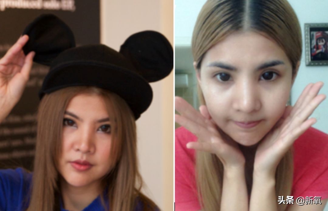 18岁土肥圆豪掷800万全身整形，鼻子6次大整假体穿出，效果却超美