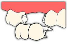 装了假牙以后还会蛀牙吗,装了假牙后可以取下来重新装吗