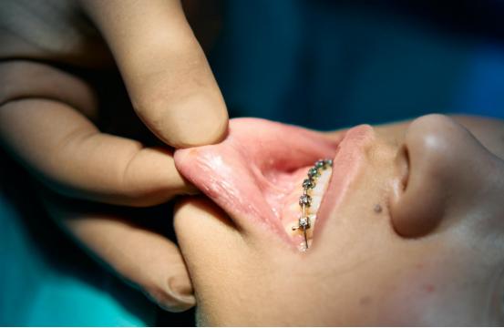 10岁小孩戴隐形牙套好还是钢牙好,青少年正畸选钢牙套还是隐形牙套