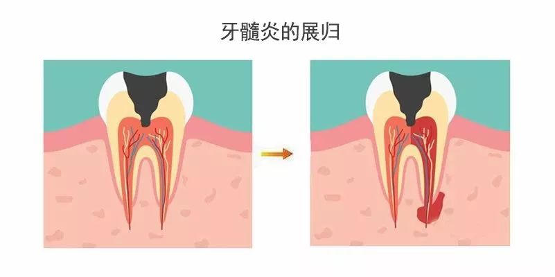 牙髓炎了不能继续再补牙吗,牙髓炎为什么不能自愈