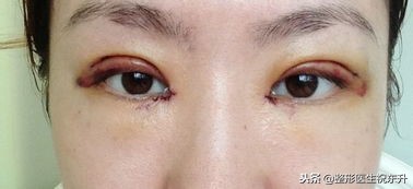 关于单眼皮整双眼皮的咨询话术,无痕双眼皮闭眼有肉条