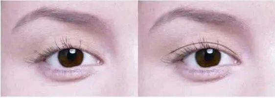 双眼皮形态分类,割双眼皮形态