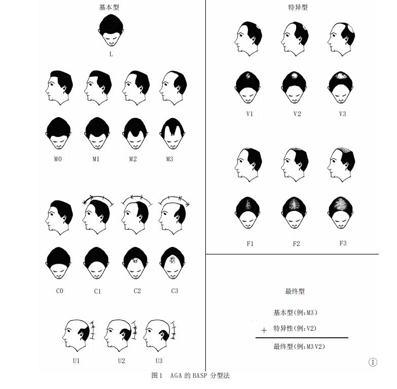 发际线脱发治疗最快的方法,脱发生发治疗最快的方法