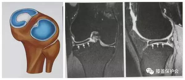 半月板最怕的动作别再做了,半月板损伤错误治疗