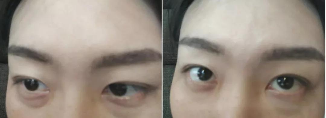 眼容易肿有黑眼圈,黑眼圈肿眼泡有什么小妙招