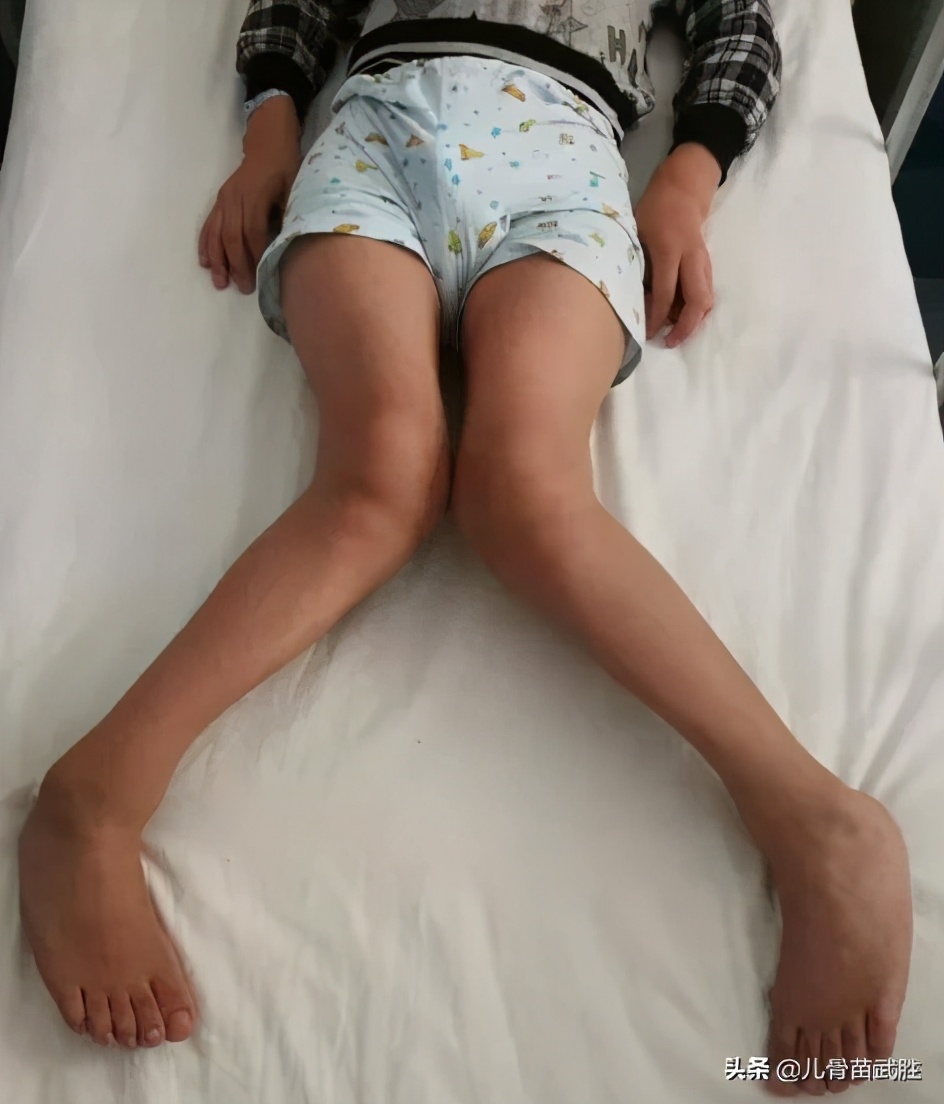 儿童肘内翻畸形,遗传右膝外翻畸形