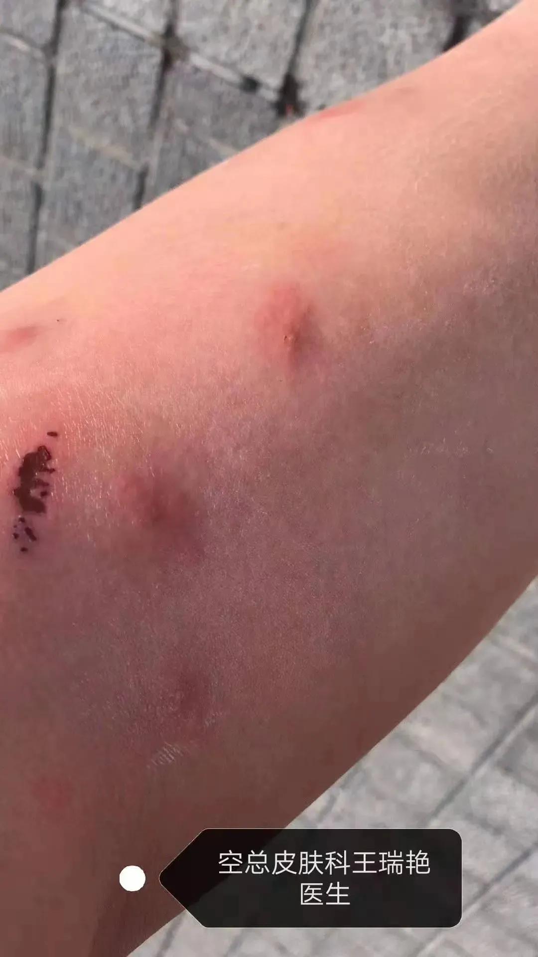 注意！洪水过后，需警惕这些皮肤问题，处理方法来了