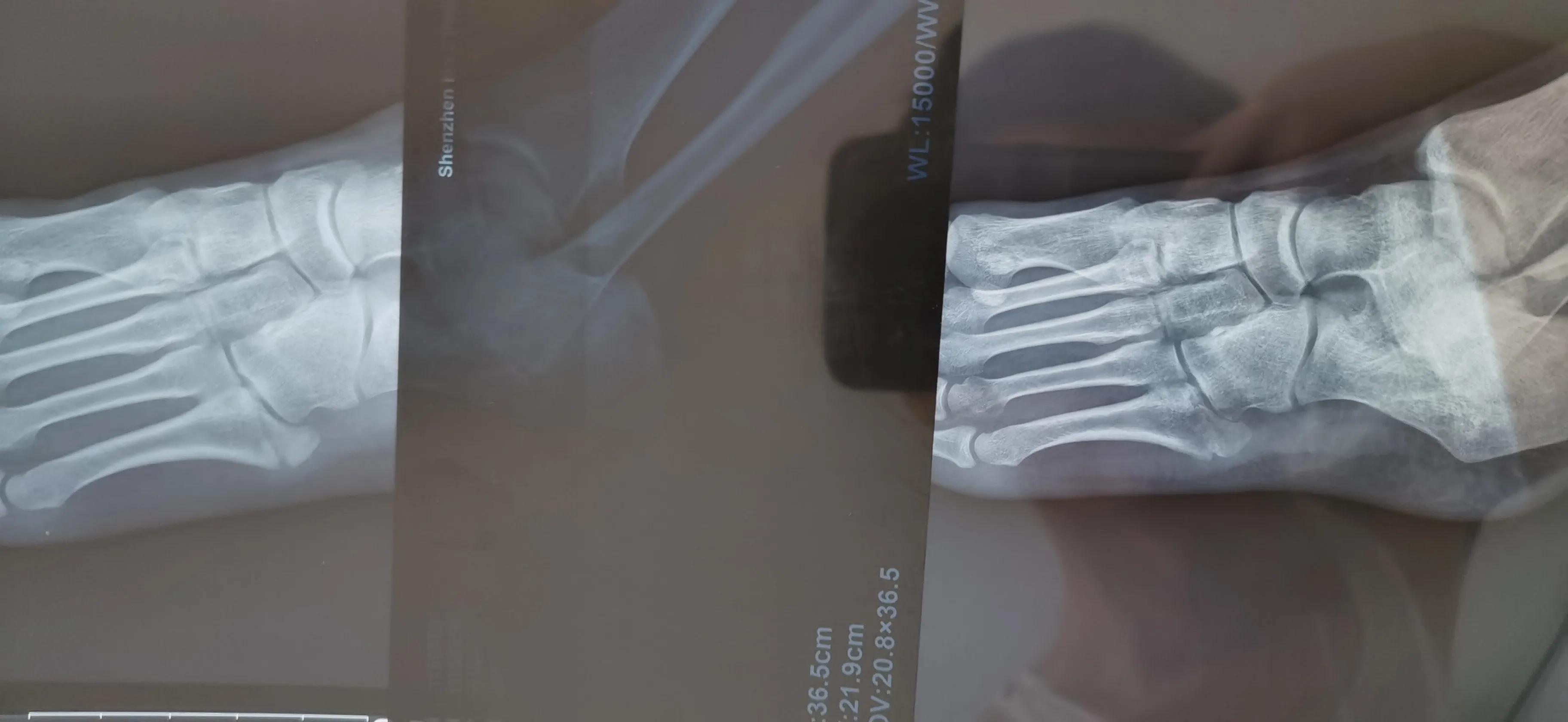 第五跖骨基底部骨折60天能走路吗,第五跖骨基底部骨折60天能脱拐吗