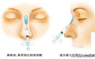 为什么有人鼻子不好看,为什么很多人鼻子不好看也很漂亮