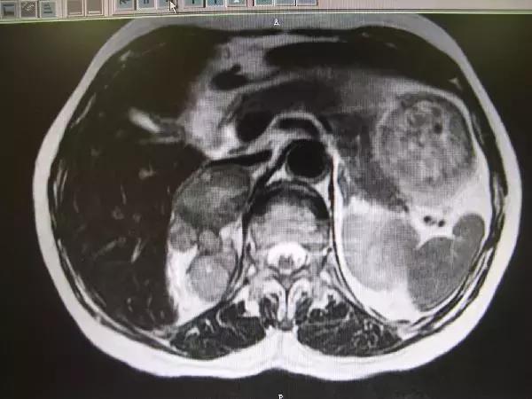 胸部ct能查出肾上腺瘤吗,检查肾上腺瘤用b超还是ct准确